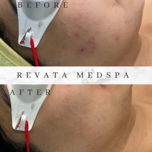 aerolase pigmentation and acne before and after treatment